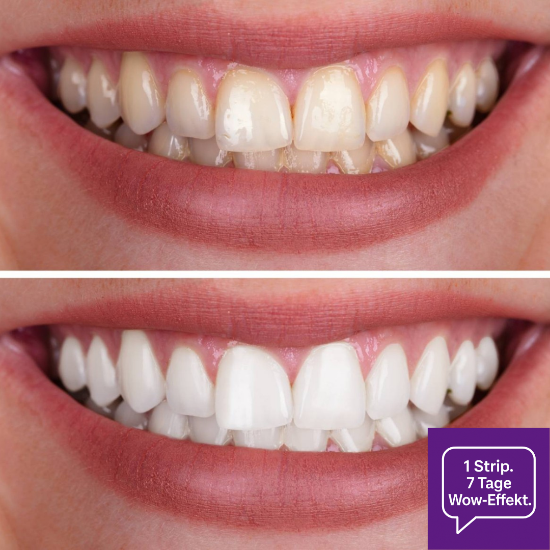 V34 Whitening Strips