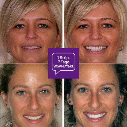 V34 Whitening Strips