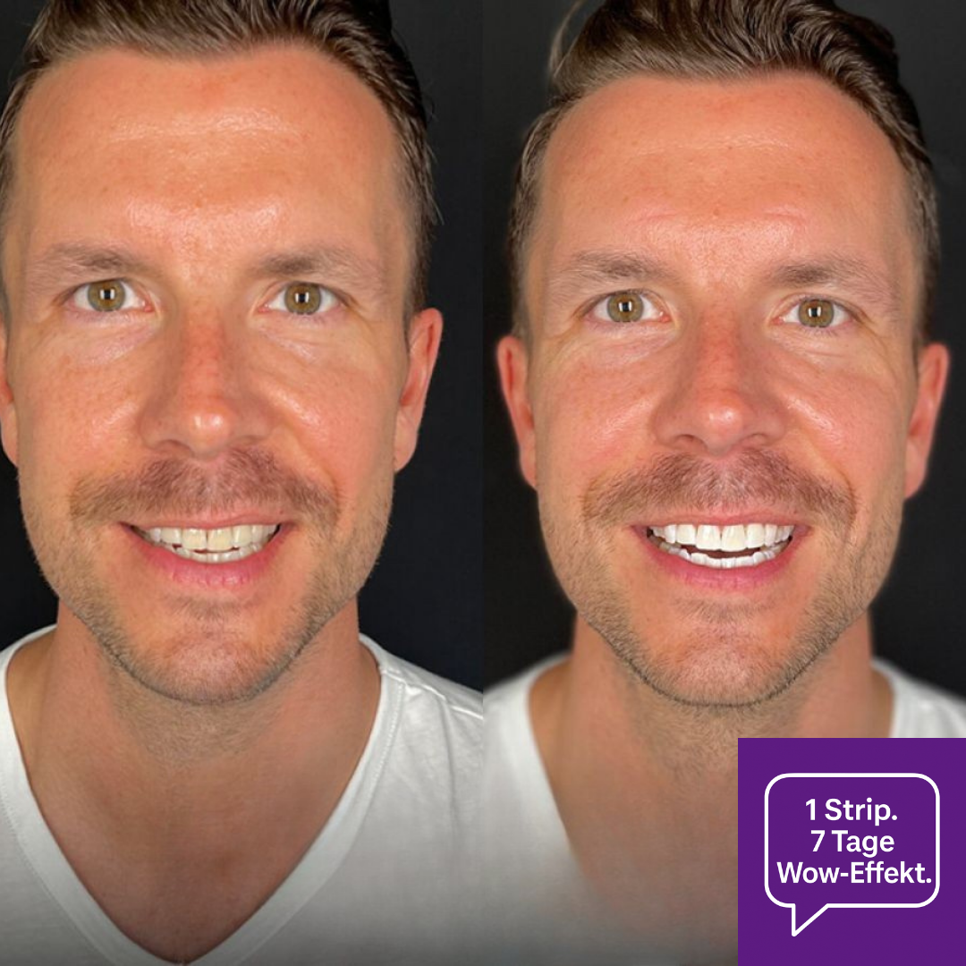 V34 Whitening Strips